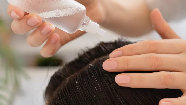 Dandruff Treatment